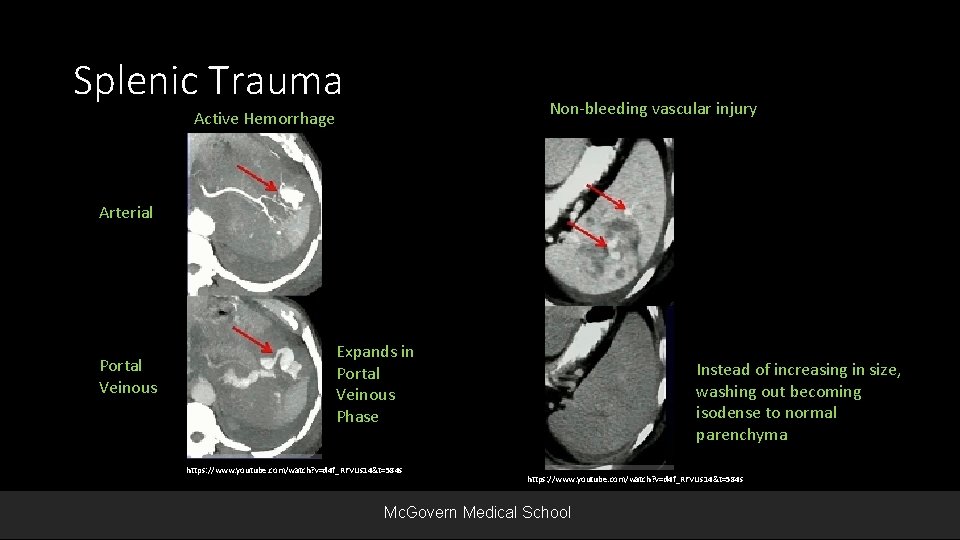 Splenic Trauma Non-bleeding vascular injury Active Hemorrhage Arterial Portal Veinous Expands in Portal Veinous