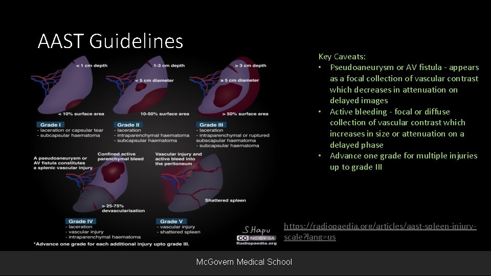 AAST Guidelines Key Caveats: • Pseudoaneurysm or AV fistula - appears as a focal