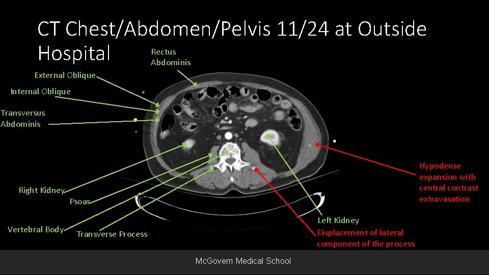 CT Chest/Abdomen/Pelvis 11/24 at Outside Rectus Hospital Abdominis External Oblique Internal Oblique Transversus Abdominis