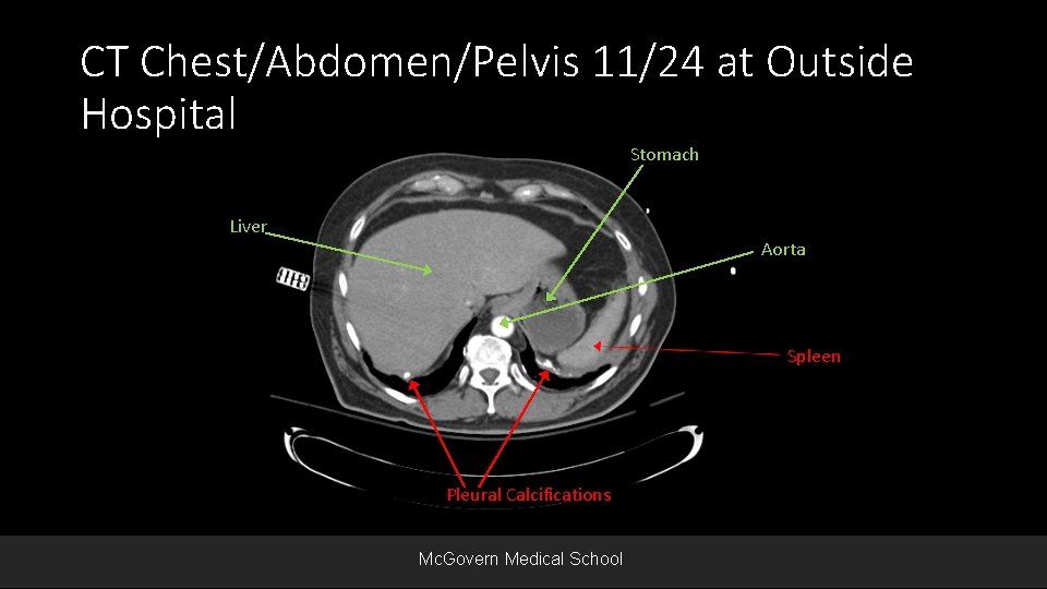 CT Chest/Abdomen/Pelvis 11/24 at Outside Hospital Stomach Liver Aorta Spleen Pleural Calcifications Mc. Govern