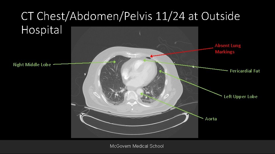 CT Chest/Abdomen/Pelvis 11/24 at Outside Hospital Absent Lung Markings Right Middle Lobe Pericardial Fat