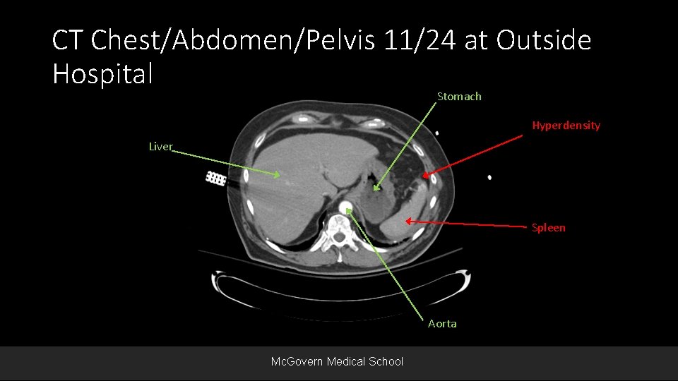 CT Chest/Abdomen/Pelvis 11/24 at Outside Hospital Stomach Hyperdensity Liver Spleen Aorta Mc. Govern Medical