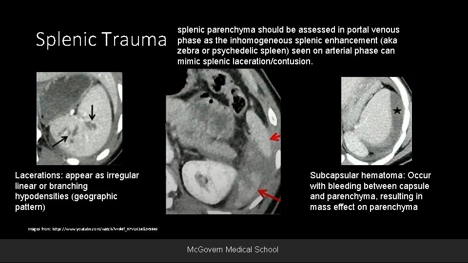 Splenic Trauma Lacerations: appear as irregular linear or branching hypodensities (geographic pattern) splenic parenchyma