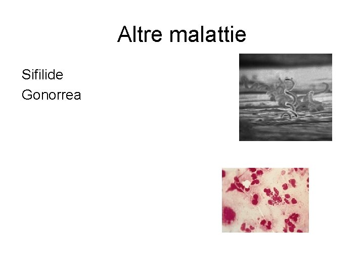 Altre malattie Sifilide Gonorrea 