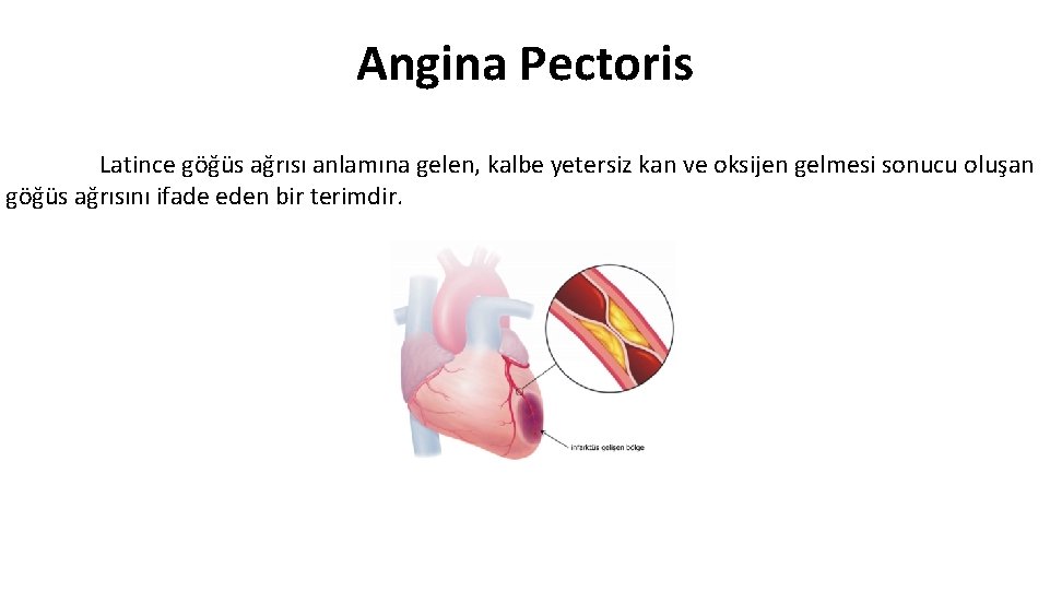 Angina Pectoris Latince göğüs ağrısı anlamına gelen, kalbe yetersiz kan ve oksijen gelmesi sonucu