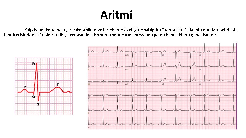 Aritmi Kalp kendine uyarı çıkarabilme ve iletebilme özelliğine sahiptir (Otomatisite). Kalbin atımları belirli bir