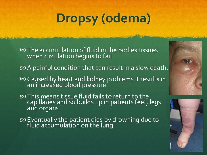 Dropsy (odema) The accumulation of fluid in the bodies tissues when circulation begins to Dropsy (odema) The accumulation of fluid in the bodies tissues when circulation begins to