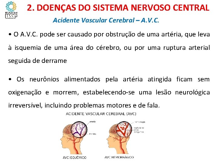 Ciências, 8º ano Sistema nervoso e as principais doenças 2. DOENÇAS DO SISTEMA NERVOSO