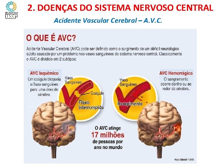 Ciências, 8º ano Sistema nervoso e as principais doenças 2. DOENÇAS DO SISTEMA NERVOSO