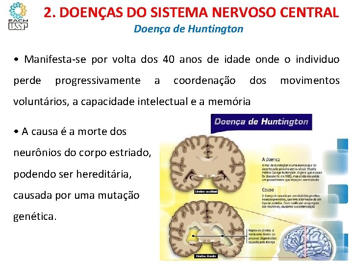 Ciências, 8º ano Sistema nervoso e as principais doenças 2. DOENÇAS DO SISTEMA NERVOSO