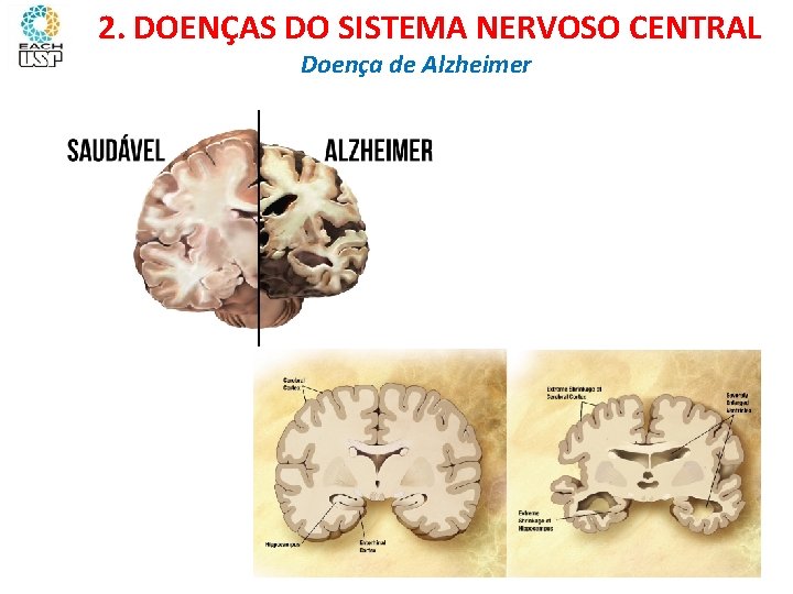 Ciências, 8º ano Sistema nervoso e as principais doenças 2. DOENÇAS DO SISTEMA NERVOSO