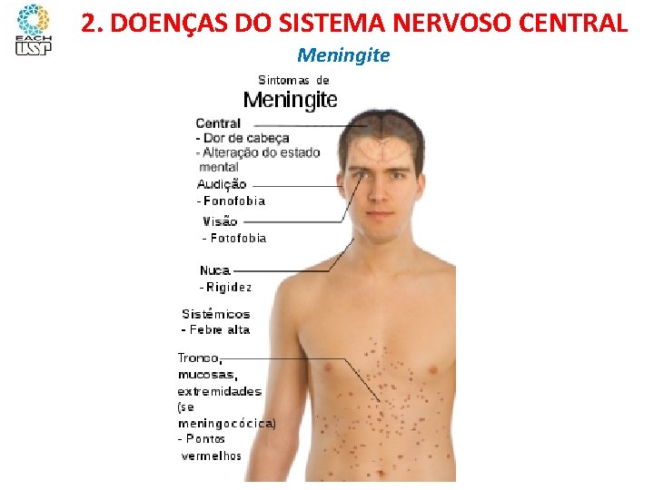 Ciências, 8º ano Sistema nervoso e as principais doenças 2. DOENÇAS DO SISTEMA NERVOSO