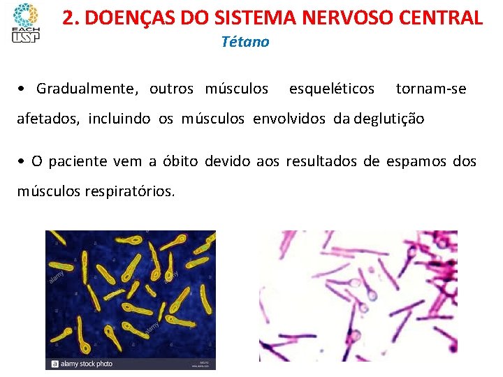 Ciências, 8º ano Sistema nervoso e as principais doenças 2. DOENÇAS DO SISTEMA NERVOSO