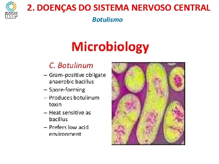 Ciências, 8º ano Sistema nervoso e as principais doenças 2. DOENÇAS DO SISTEMA NERVOSO