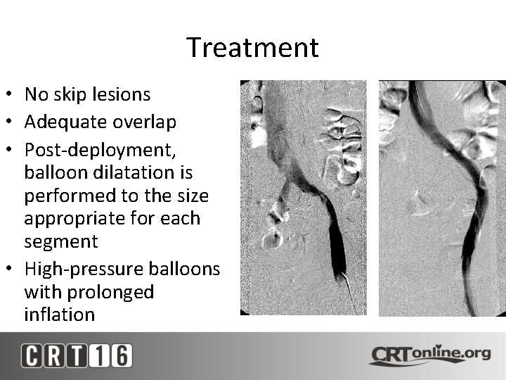 Treatment • No skip lesions • Adequate overlap • Post-deployment, balloon dilatation is performed