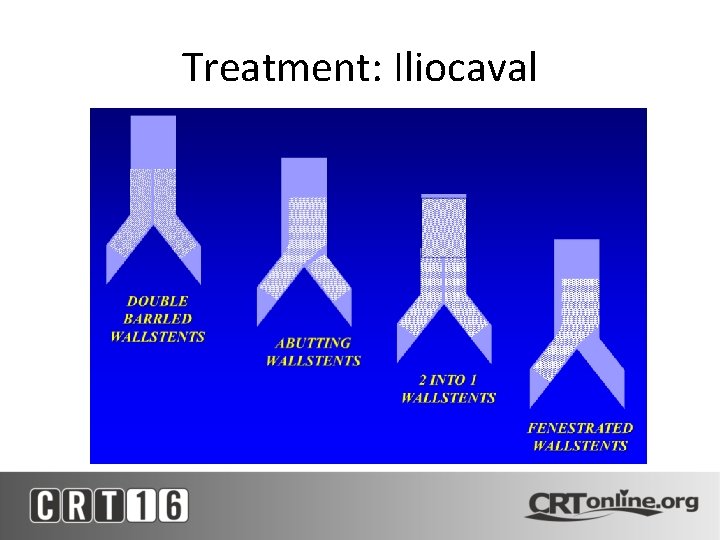 Treatment: Iliocaval 