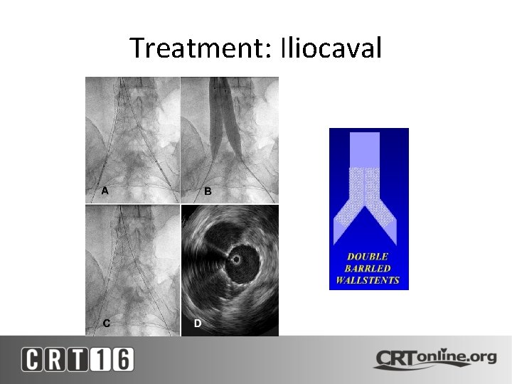 Treatment: Iliocaval 