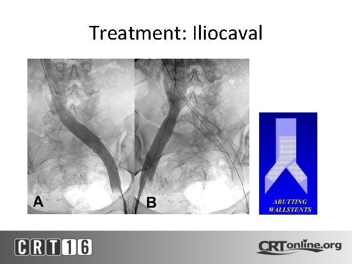 Treatment: Iliocaval 