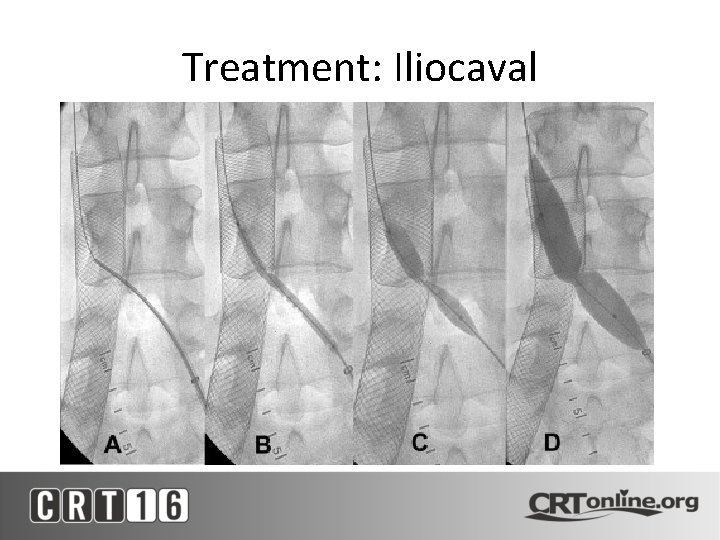 Treatment: Iliocaval 