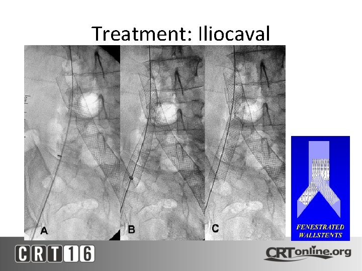 Treatment: Iliocaval 