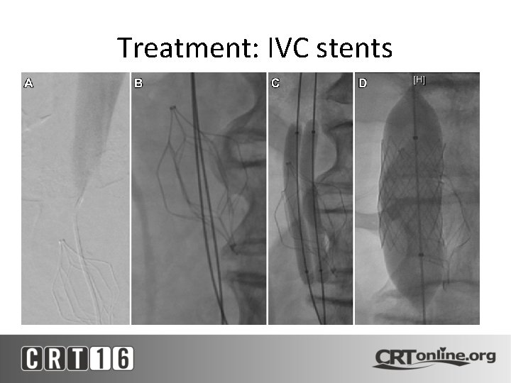 Treatment: IVC stents 
