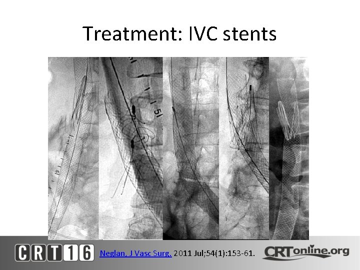 Treatment: IVC stents Neglan, J Vasc Surg. 2011 Jul; 54(1): 153 -61. 