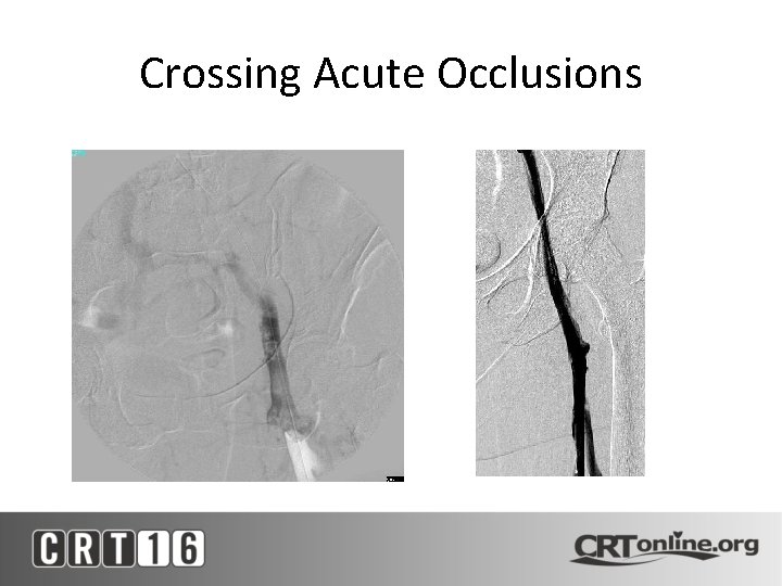 Crossing Acute Occlusions 