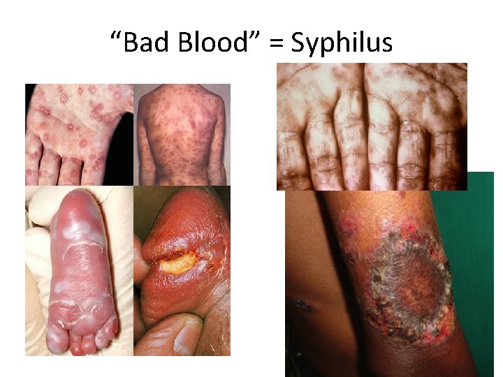 “Bad Blood” = Syphilus 