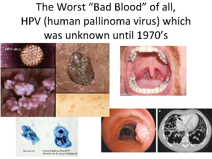 The Worst “Bad Blood” of all, HPV (human pallinoma virus) which was unknown until