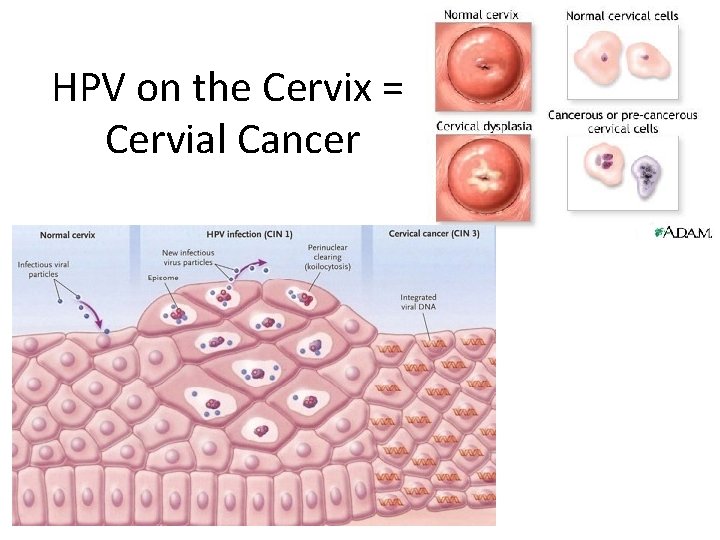 HPV on the Cervix = Cervial Cancer 