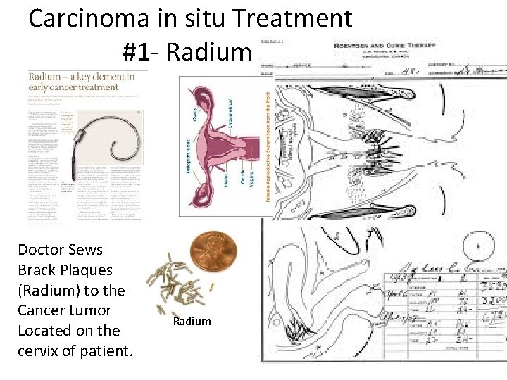 Carcinoma in situ Treatment #1 - Radium Doctor Sews Brack Plaques (Radium) to the