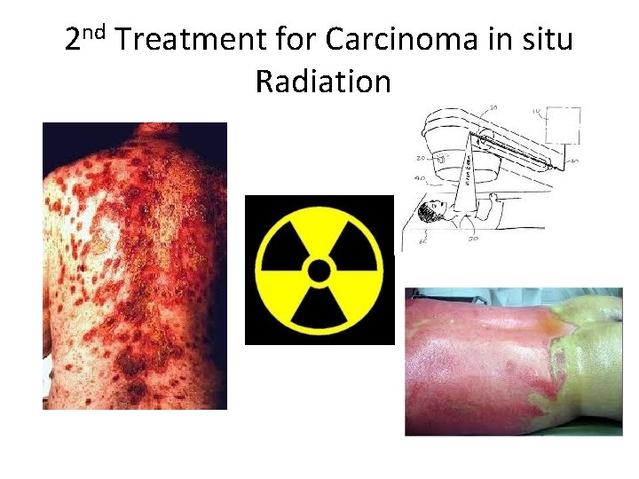 2 nd Treatment for Carcinoma in situ Radiation 