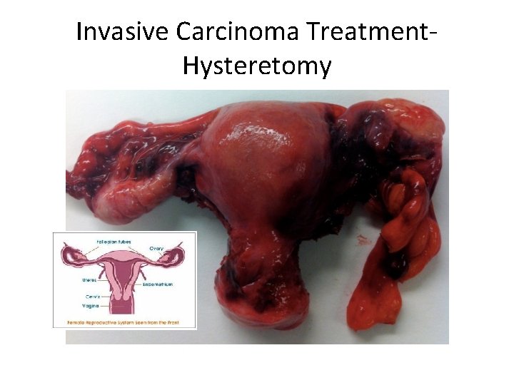 Invasive Carcinoma Treatment. Hysteretomy 
