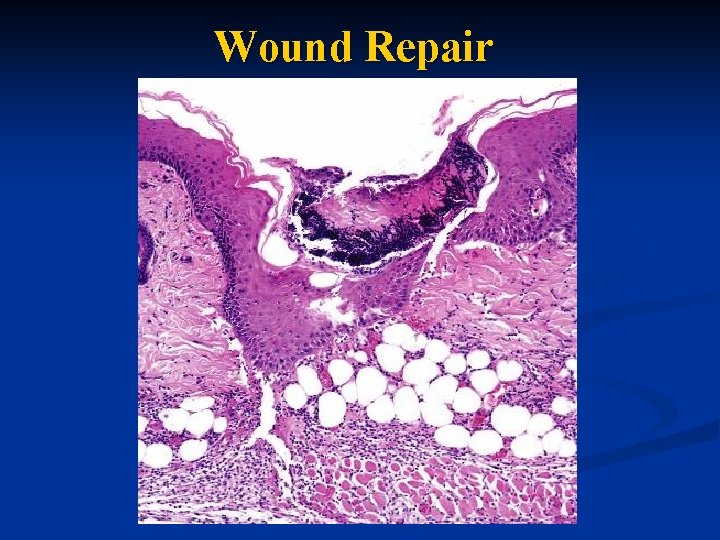 Wound Repair 