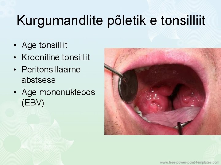 Kurgumandlite põletik e tonsilliit • Äge tonsilliit • Krooniline tonsilliit • Peritonsillaarne abstsess •