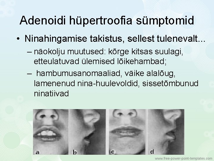 Adenoidi hüpertroofia sümptomid • Ninahingamise takistus, sellest tulenevalt. . . – näokolju muutused: kõrge