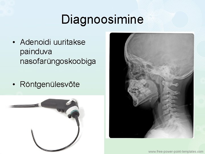 Diagnoosimine • Adenoidi uuritakse painduva nasofarüngoskoobiga • Röntgenülesvõte 