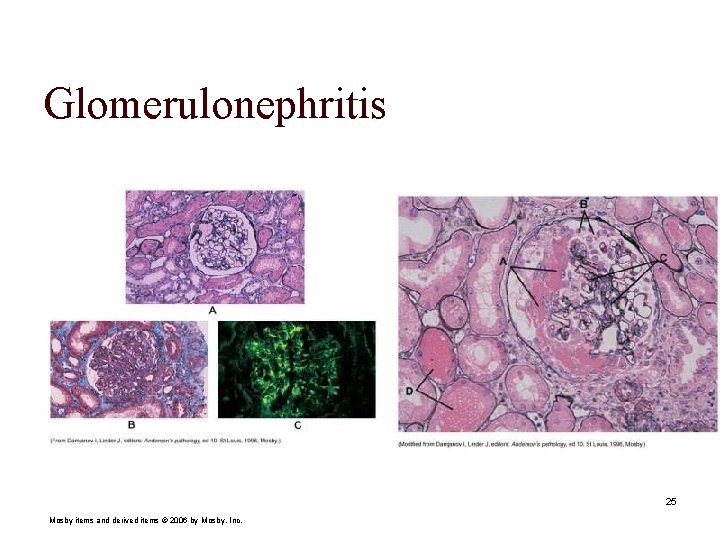 Glomerulonephritis 25 Mosby items and derived items © 2006 by Mosby, Inc. 