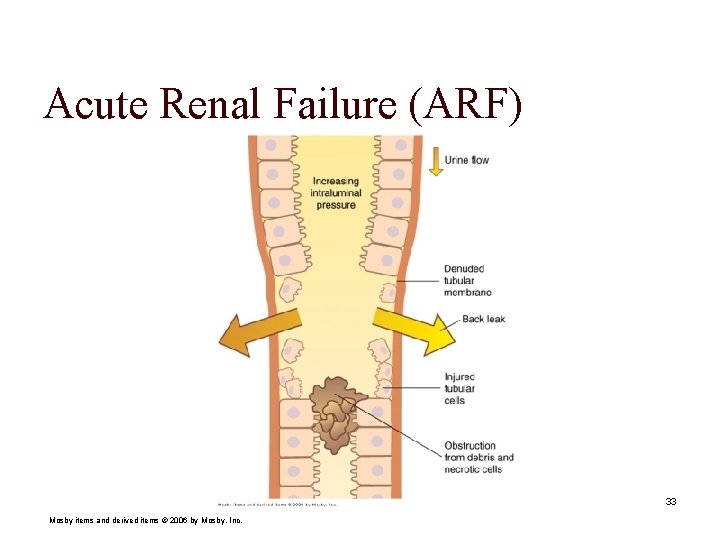 Acute Renal Failure (ARF) 33 Mosby items and derived items © 2006 by Mosby,