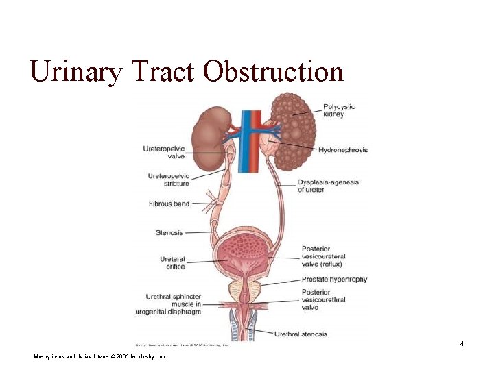 Urinary Tract Obstruction 4 Mosby items and derived items © 2006 by Mosby, Inc.
