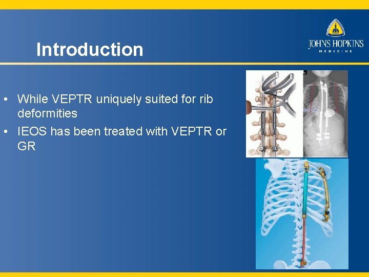 Introduction • While VEPTR uniquely suited for rib deformities • IEOS has been treated