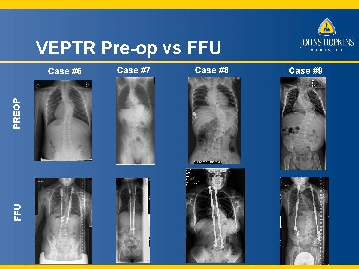 VEPTR Pre-op vs FFU PREOP Case #6 Case #7 Case #8 Case #9 