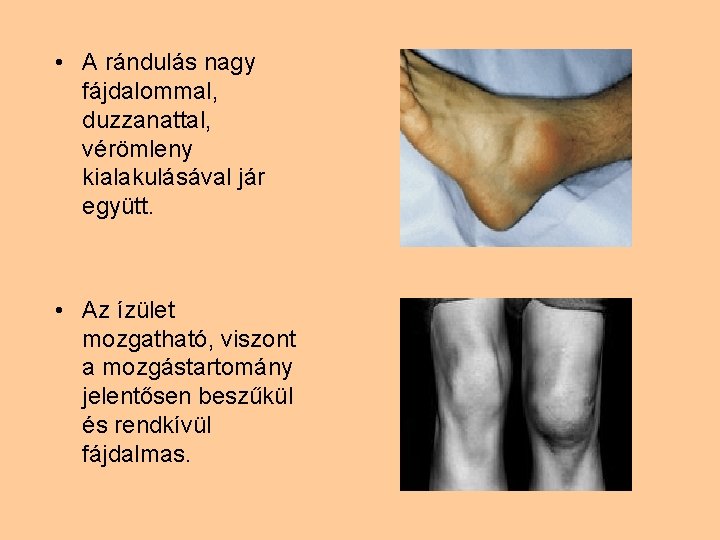 • A rándulás nagy fájdalommal, duzzanattal, vérömleny kialakulásával jár együtt. • Az ízület • A rándulás nagy fájdalommal, duzzanattal, vérömleny kialakulásával jár együtt. • Az ízület