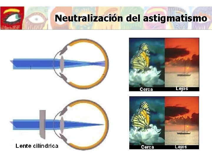 Neutralización del astigmatismo Neutralización del astigmatismo