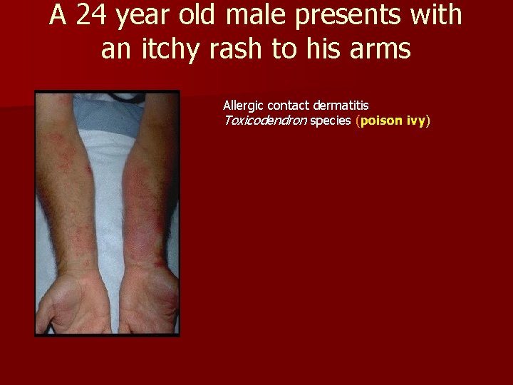 A 24 year old male presents with an itchy rash to his arms Allergic A 24 year old male presents with an itchy rash to his arms Allergic
