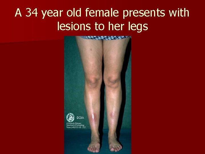 A 34 year old female presents with lesions to her legs A 34 year old female presents with lesions to her legs