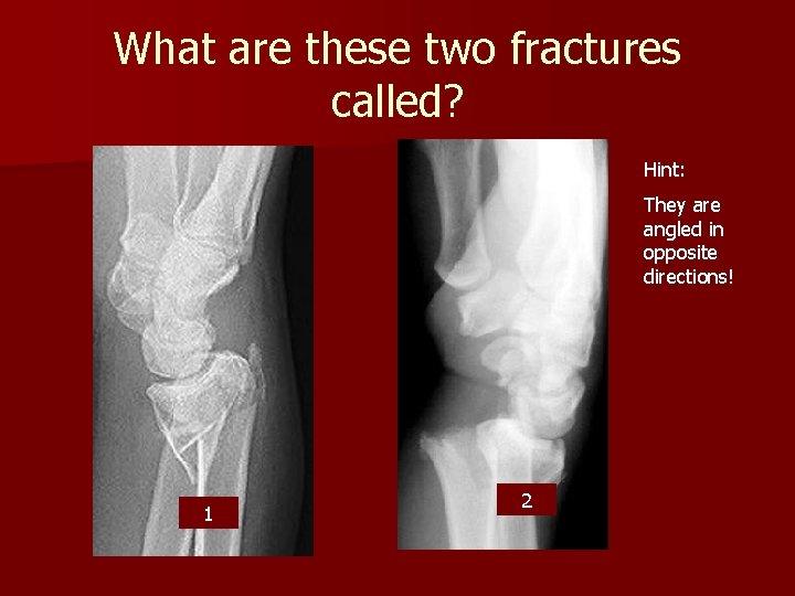 What are these two fractures called? Hint: They are angled in opposite directions! 1 What are these two fractures called? Hint: They are angled in opposite directions! 1