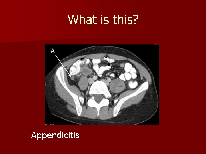 What is this? Appendicitis What is this? Appendicitis