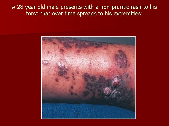 A 28 year old male presents with a non-pruritic rash to his torso that A 28 year old male presents with a non-pruritic rash to his torso that