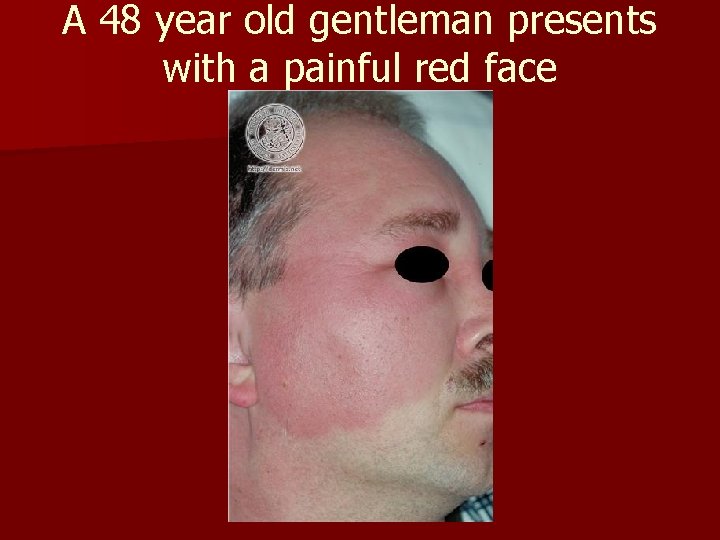 A 48 year old gentleman presents with a painful red face A 48 year old gentleman presents with a painful red face